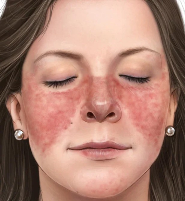 الذئبة الحمراء (lupus erythematosus)