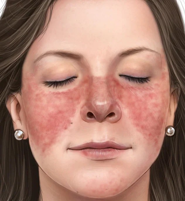 الذئبة الحمراء (lupus erythematosus)