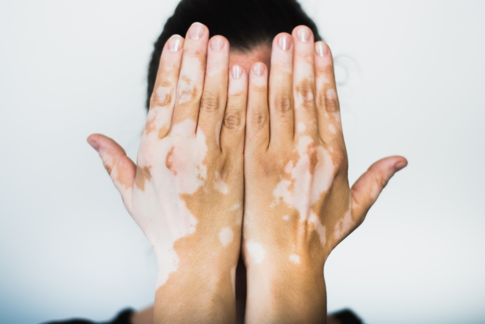 بهاق (Vitiligo)